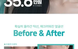 통합/랜딩/피부/온다리프팅2/250409